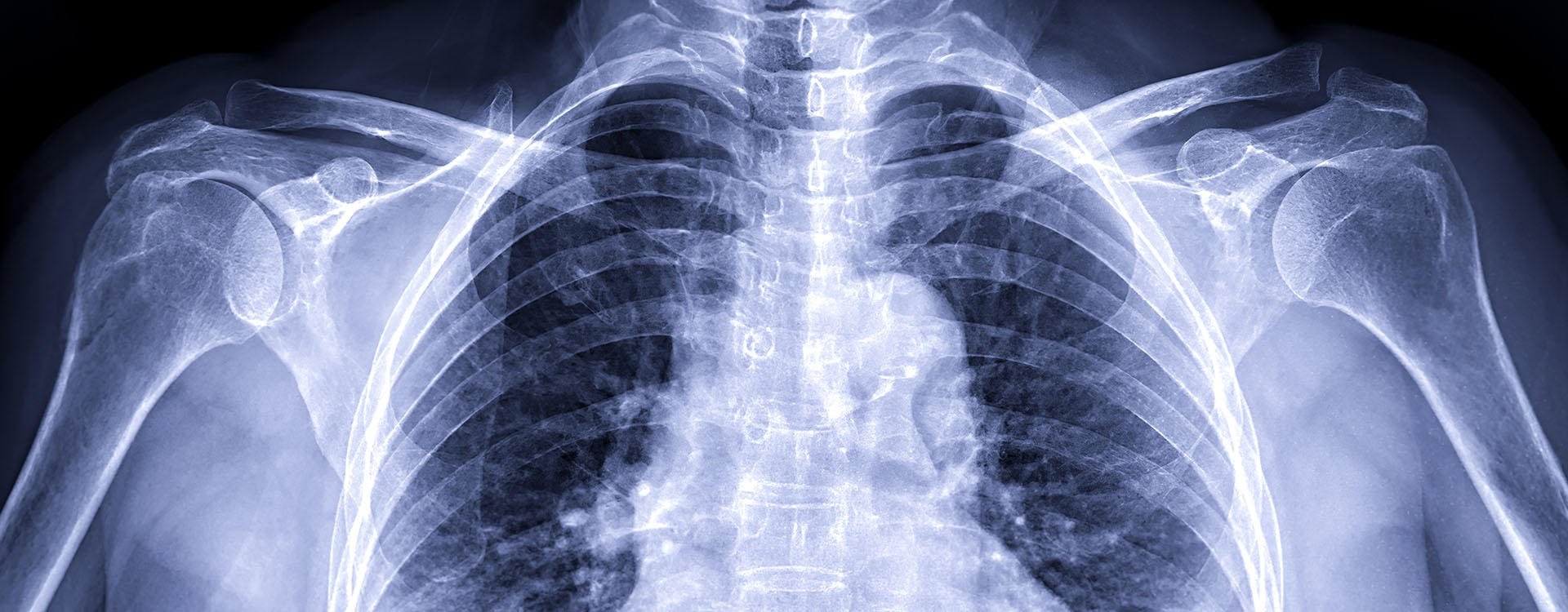 X-ray shoulder transaxillary view for diagnosis fracture